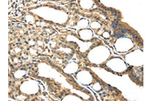 The image on the left is immunohistochemistry of paraffin-embedded Human thyroid cancer tissue using ABIN7191125(ISM2 Antibody) at dilution 1/45, on the right is treated with synthetic peptide. (Isthmin 2 Antikörper)