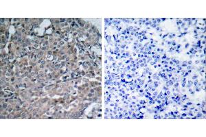 Peptide - +Immunohistochemical analysis of paraffin-embedded human breast carcinoma tissue using FAK (Ab-925) antibody (#B7083). (FAK Antikörper  (Tyr925))
