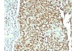 Formalin-fixed, paraffin-embedded human bladder carcinoma stained with Nucleolin antibody. (Nucleolin Antikörper)