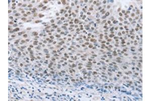 The image on the left is immunohistochemistry of paraffin-embedded Human liver cancer tissue using ABIN7191633(NEUROG2 Antibody) at dilution 1/15, on the right is treated with synthetic peptide. (Neurogenin 2 Antikörper)