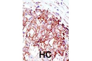 Formalin-fixed and paraffin-embedded human hepatocellular carcinoma tissue reacted with MIB1 polyclonal antibody  , which was peroxidase-conjugated to the secondary antibody, followed by AEC staining. (MIB1 Antikörper  (N-Term))