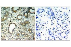 Immunohistochemical analysis of paraffin-embedded human breast carcinoma tissue using SHP-2(Phospho-Tyr580) Antibody(left) or the same antibody preincubated with blocking peptide(right).