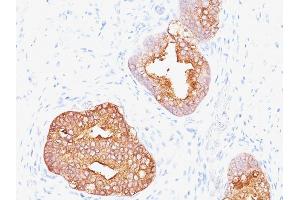 Formalin-fixed, paraffin-embedded human Prostate Carcinoma stained with Prostate Specific Antigen Mouse Monoclonal Antibody (1A7). (Prostate Specific Antigen Antikörper)