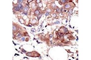 IHC analysis of FFPE human breast carcinoma tissue stained with the MUSK antibody (MUSK Antikörper  (AA 829-859))