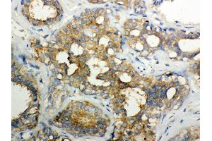 Anti- Calpain1 Picoband antibody, IHC(P) IHC(P): Human Mammary Cancer Tissue (CAPNL1 Antikörper  (AA 396-555))