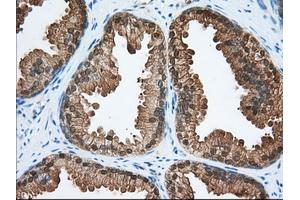 Immunohistochemical staining of paraffin-embedded Adenocarcinoma of Human colon tissue using anti-ACAT2 mouse monoclonal antibody. (ACAT2 Antikörper)