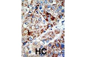 Formalin-fixed and paraffin-embedded human hepatocellular carcinoma tissue reacted with USP21 polyclonal antibody , which was peroxidase-conjugated to the secondary antibody, followed by AEC staining. (USP21 Antikörper  (N-Term))