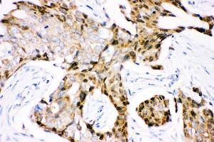 Anti- Ubiquitin Picoband antibody, IHC(P) IHC(P): Human Mammary Cancer Tissue (Ubiquitin B Antikörper  (AA 77-152))