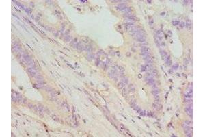 Immunohistochemistry of paraffin-embedded human colon cancer using ABIN7149695 at dilution of 1:100 (DMP1 Antikörper  (AA 254-513))