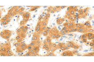 Immunohistochemistry of paraffin-embedded Human liver cancer using MAP2K6 Polyclonal Antibody at dilution of 1:30 (MAP2K6 Antikörper)