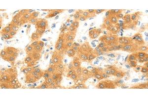 Immunohistochemistry of paraffin-embedded Human liver cancer using MAP2K6 Polyclonal Antibody at dilution of 1:30 (MAP2K6 Antikörper)