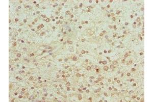 Immunohistochemistry of paraffin-embedded human glioma using ABIN7153904 at dilution of 1:100 (PGM2L1 Antikörper  (AA 101-400))