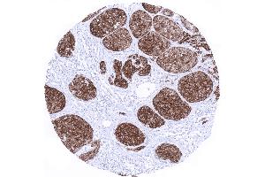 Skin Malignant melanoma with strong Melan A positivity in all tumor cells (Rekombinanter MLANA Antikörper)