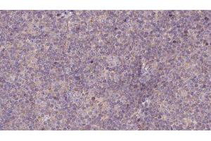 ABIN6273145 at 1/100 staining Human lymph cancer tissue by IHC-P.