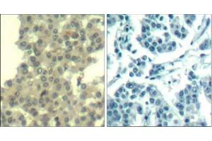 Immunohistochemical analysis of paraffin-embedded human breast carcinoma tissue using Her3/ErbB3 (Ab-1328) Antibody (E021510). (ERBB3 Antikörper)