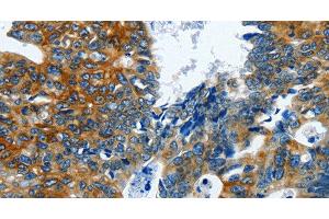 Immunohistochemistry of paraffin-embedded Human colon cancer using BPIFB3 Polyclonal Antibody at dilution of 1:120 (BPIFB3 Antikörper)