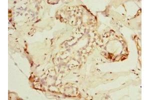 Immunohistochemistry of paraffin-embedded human breast cancer using ABIN7143282 at dilution of 1:100 (ADAD1 Antikörper  (AA 1-280))