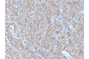 Formalin-fixed, paraffin-embedded human Melanoma stained with CD63 Mouse Monoclonal Antibody (LAMP3/2790) (CD63 Antikörper  (AA 100-197))