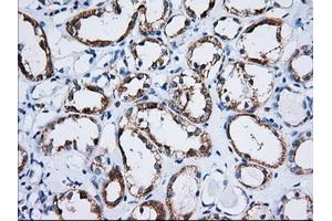 Immunohistochemical staining of paraffin-embedded Carcinoma of Human thyroid tissue using anti-TTC32 mouse monoclonal antibody. (TTC32 Antikörper)