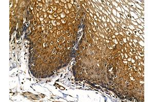 ABIN6262608 and ABIN6268730 at 1/100 staining Human esophageal cancer and adjacent normal tissues by IHC-P.