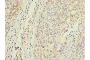 Immunohistochemistry of paraffin-embedded human cervical cancer using ABIN7150355 at dilution of 1:100 (APEX1 Antikörper  (AA 32-318))
