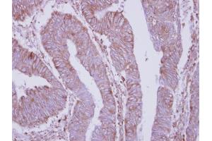 IHC-P Image Immunohistochemical analysis of paraffin-embedded human colon carcinoma, using DPY19L4, antibody at 1:250 dilution. (DPY19L4 Antikörper  (C-Term))