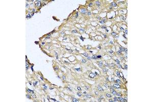 Immunohistochemistry of paraffin-embedded human prostate cancer using ASIP antibody at dilution of 1:100 (40x lens). (ASIP Antikörper)