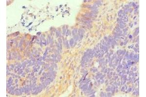 Immunohistochemistry of paraffin-embedded human ovarian cancer using ABIN7170114 at dilution of 1:100 (GLUT1 Antikörper  (AA 210-310))