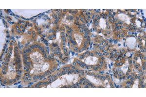 Immunohistochemistry of paraffin-embedded Human thyroid cancer tissue using PLIN1 Polyclonal Antibody at dilution 1:30 (PLIN1 Antikörper)