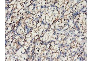Immunohistochemical staining of paraffin-embedded Carcinoma of Human kidney tissue using anti-CDH2 mouse monoclonal antibody. (N-Cadherin Antikörper)