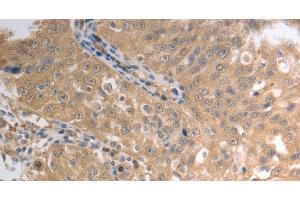 Immunohistochemistry of paraffin-embedded Human ovarian cancer using SLC1A4 Polyclonal Antibody at dilution of 1:70 (SLC1A4 Antikörper)