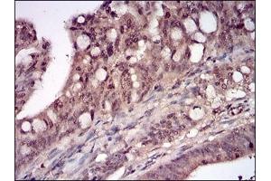 Immunohistochemical analysis of paraffin-embedded human rectum cancer tissues using DDIT3 mouse mAb with DAB staining.