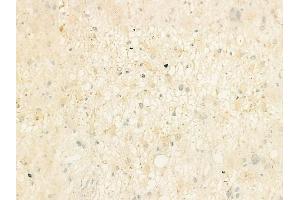 ABIN6264637 and ABIN6273153 at 1/100 staining human astrocytoma by IHC-P.