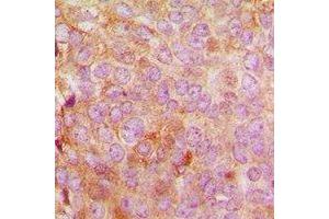 Immunohistochemical analysis of MRPL48 staining in human breast cancer formalin fixed paraffin embedded tissue section. (MRPL48 Antikörper  (C-Term))