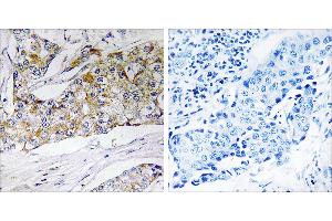 Peptide - +Immunohistochemistry analysis of paraffin-embedded human breast carcinoma tissue using DHRS11 antibody.