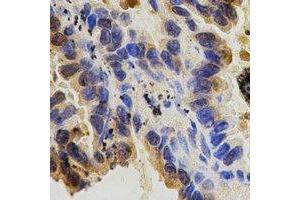 Immunohistochemical analysis of CD29 staining in human lung cancer formalin fixed paraffin embedded tissue section. (ITGB1 Antikörper  (C-Term))
