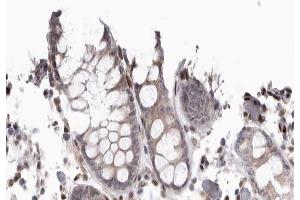 ABIN6267667 at 1/200 staining human colon cancer tissue sections by IHC-P.