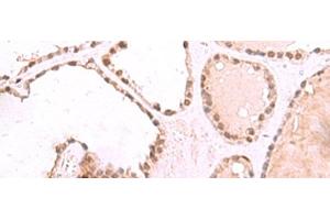 Immunohistochemistry of paraffin-embedded Human thyroid cancer tissue using RUVBL1 Polyclonal Antibody at dilution of 1:85(x200) (RUVBL1 Antikörper)