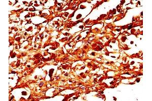 IHC image of ABIN7173988 diluted at 1:300 and staining in paraffin-embedded human melanoma performed on a Leica BondTM system. (TYR Antikörper  (AA 19-377))