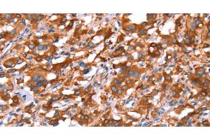 Immunohistochemistry of paraffin-embedded Human thyroid cancer tissue using GAS8 Polyclonal Antibody at dilution 1:40 (GAS8 Antikörper)