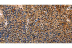 Immunohistochemistry of paraffin-embedded Human liver cancer tissue using MUSK Polyclonal Antibody at dilution of 1:30 (MUSK Antikörper)