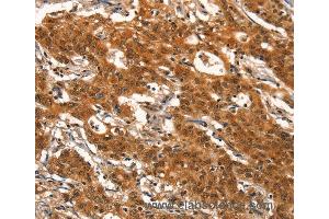 Immunohistochemistry of Human gastic cancer using DEAF1 Polyclonal Antibody at dilution of 1:40