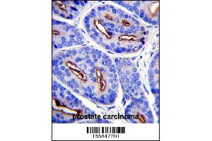 FOLH1 Antibody immunohistochemistry analysis in formalin fixed and paraffin embedded human prostate carcinoma followed by peroxidase conjugation of the secondary antibody and DAB staining. (PSMA Antikörper  (N-Term))