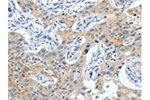 The image on the left is immunohistochemistry of paraffin-embedded Human lung cancer tissue using ABIN7190319(CNTNAP3 Antibody) at dilution 1/40, on the right is treated with synthetic peptide. (CNTNAP3 Antikörper)
