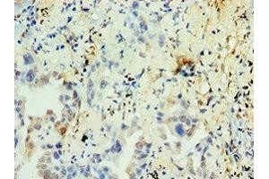 Immunohistochemistry of paraffin-embedded human lung cancer using ABIN7161904 at dilution of 1:100 (TR4 Antikörper  (AA 240-380))