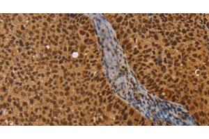 Immunohistochemistry of paraffin-embedded Human cervical cancer using CEL Polyclonal Antibody at dilution of 1:40 (Cholesterol Esterase Antikörper)