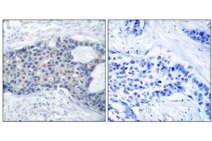 Immunohistochemical analysis of paraffin-embedded human breast carcinoma tissue using Zap-70(Phospho-Tyr493) Antibody(left) or the same antibody preincubated with blocking peptide(right). (ZAP7 (pTyr493) Antikörper)
