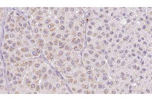 ABIN6277683 at 1/100 staining Human melanoma tissue by IHC-P. (PLAT Antikörper  (C-Term))