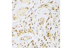 Immunohistochemistry of paraffin-embedded human gastric cancer using RPL13 Antibody (ABIN2559760) at dilution of 1:100 (40x lens). (RPL13 Antikörper)