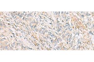 Immunohistochemistry of paraffin-embedded Human ovarian cancer tissue using HBZ Polyclonal Antibody at dilution of 1:120(x200) (HBZ Antikörper)